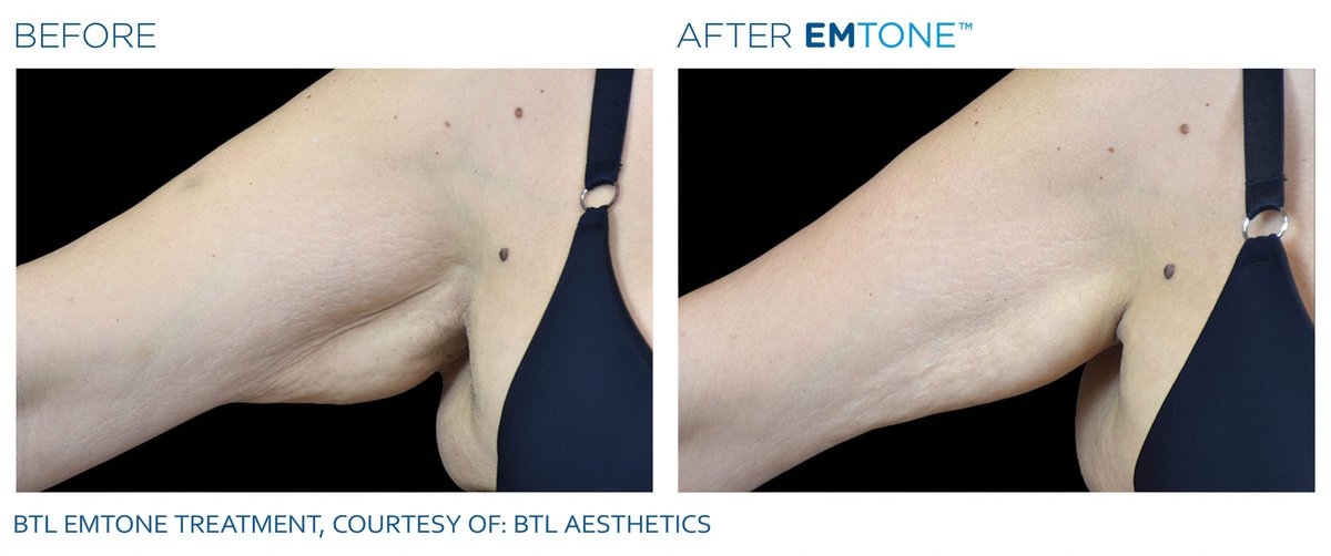 EMTONE before after_arm