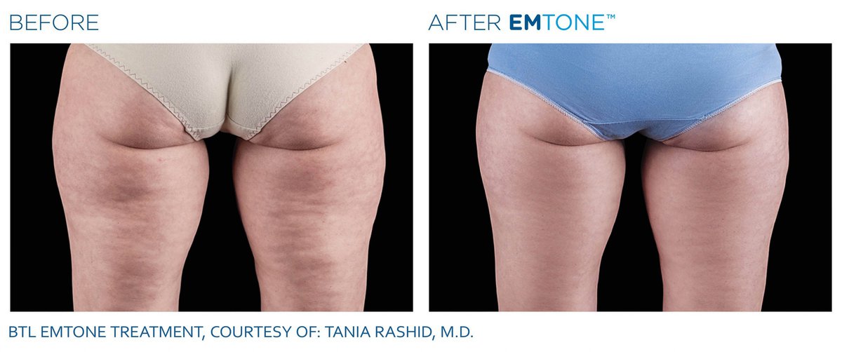 EMTONE beforeafter_thigh