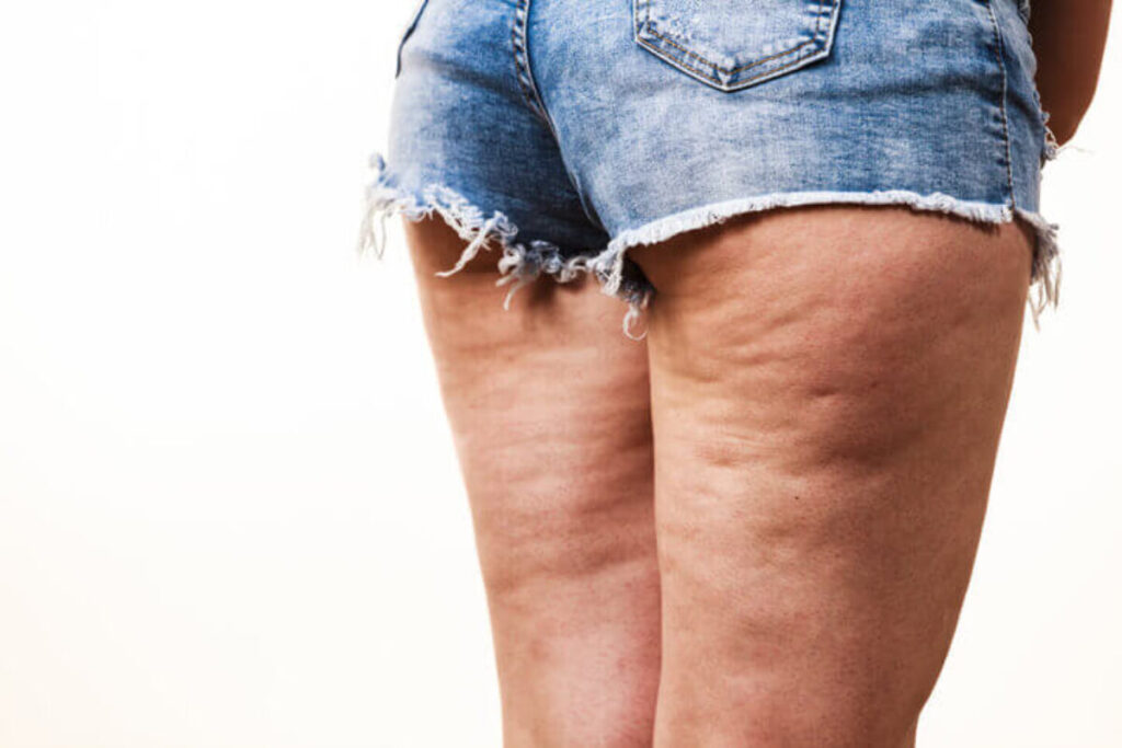 Understanding cellulite (An In-Depth Look at the EMTONE Approach)